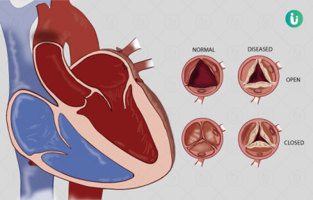 Study of prevalence of rheumatic heart disease among school children in ...